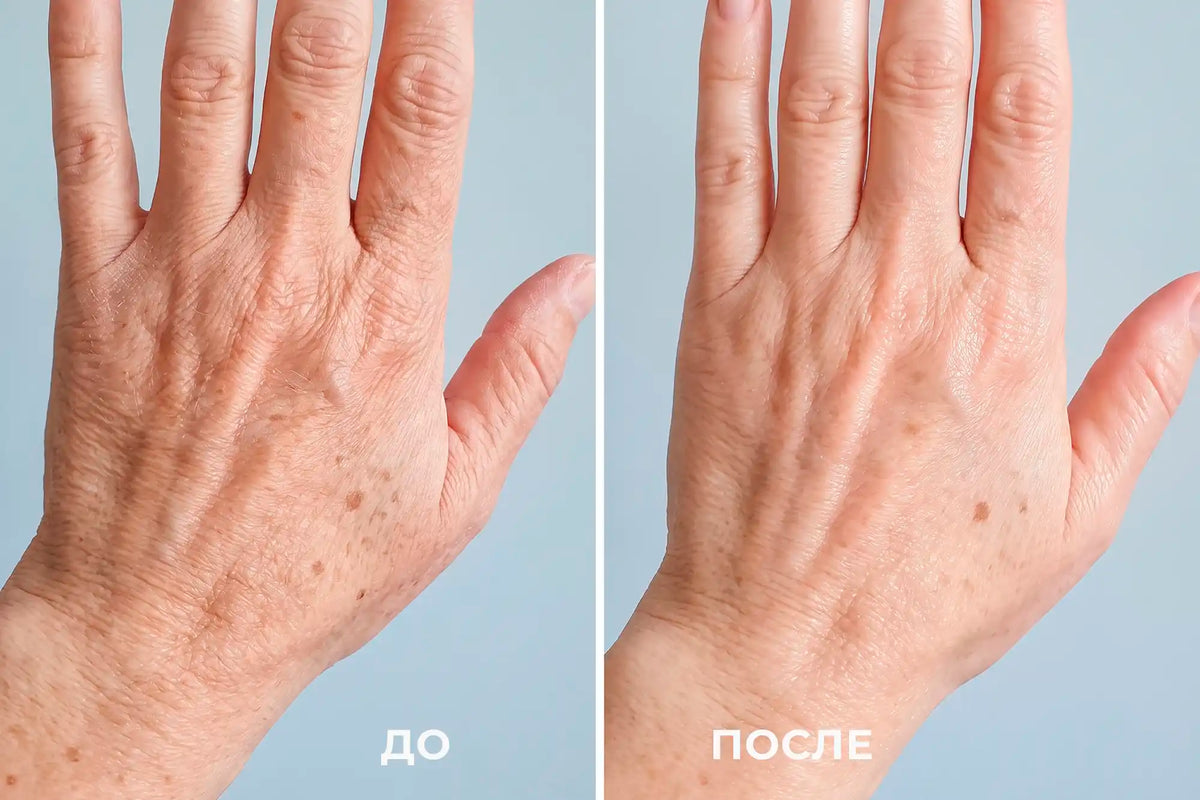 LED HAND - maska do fototerapii dłoni