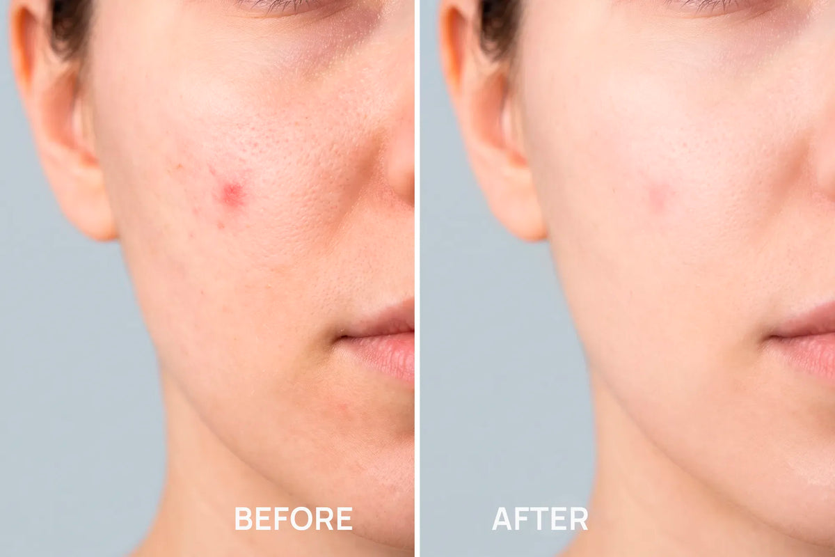 LED PATCHES - Facial skin care